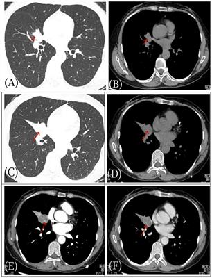 Application of 18F-FDG PET/CT imaging in a primary angiomatoid fibrous histiocytoma of pulmonary bronchus: case report and literature review